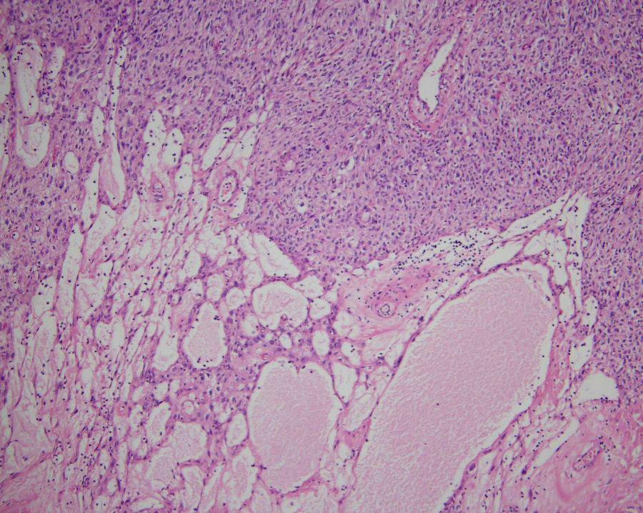 Case 6 Clinical history : Male, 57 19 cm tumor in the