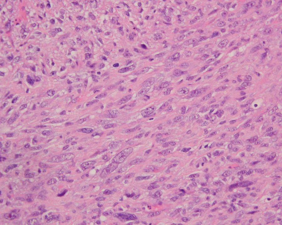 6 cm tumor in the duodenal