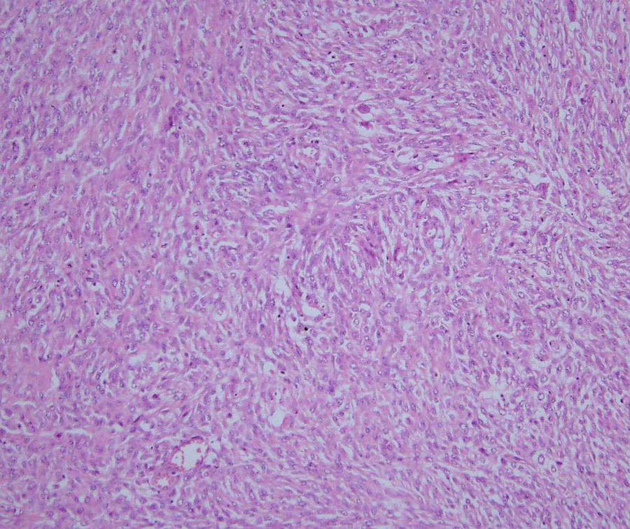 Histological features: The tumor