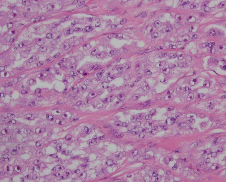 Histological features: The tumor is