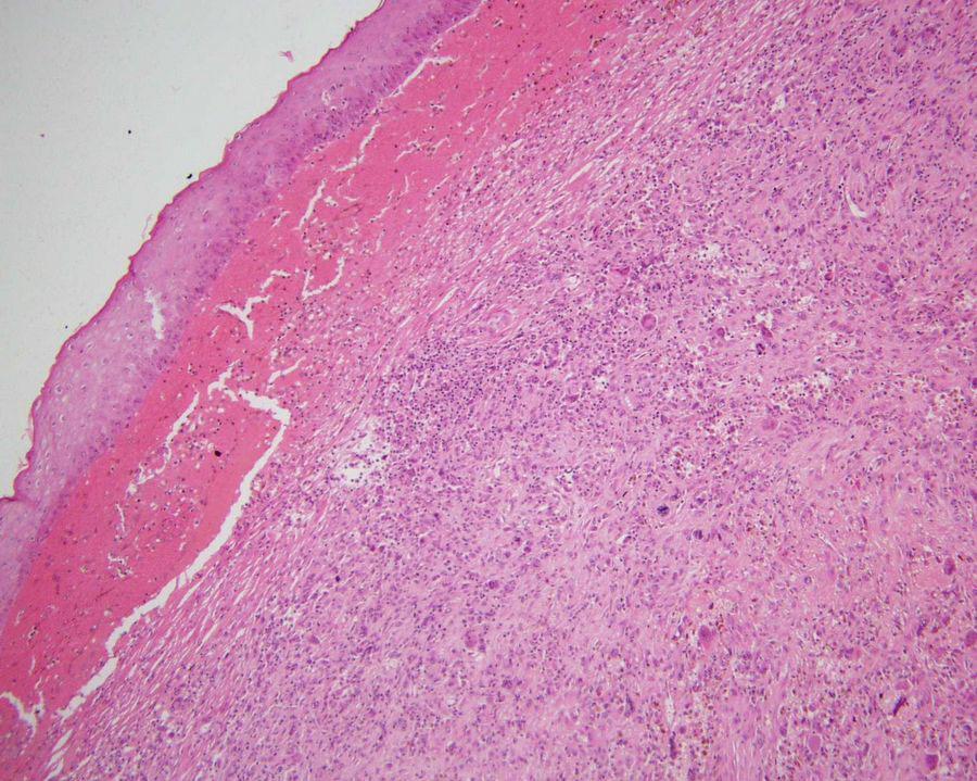 Case 13 Clinical history : Female, 85.