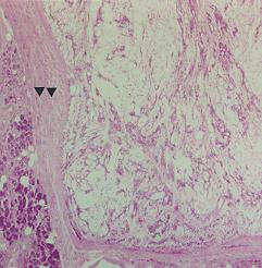 Pleomorphic adenoma, parotid; cords and islands of cells with basophilic nuclei.