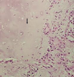 Pleomorphic adenoma, parotid; well-formed capsule separates tumor (double