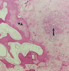 Pleomorphic adenoma, parotid; osseous