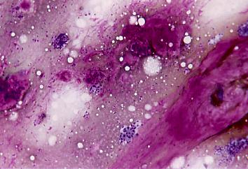 This low power image shows abundant metachromatic staining stroma mixed with small clusters of epithelial cells.