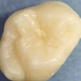 C D A J O U R N A L, V O L 3 5, N º 1 0 TABLE 6 Occlusal Protocol*** ICDAS code 0 1 2 3 4 5 6 Definitions Sound tooth surface; no caries change after air drying (5 sec); or hypoplasia, wear, erosion,