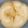 dentin; cavity is deep and wide involving more than half of the tooth Histologic depth Lesion depth in P/F was 90% in the outer enamel with only 10% into dentin Lesion depth in P/F was 50% inner