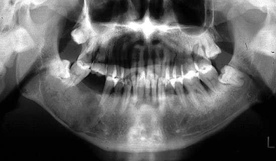 Cemento-ossifying Fibroma Can occur in any decade, but most common in young adults F>M Usually discovered due to facial asymmetry Cemento-ossifying Fibroma Location Most common in the mandible