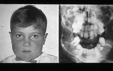 Am J Hum Genet 65(1):158-166 Location Bilateral, multilocular lesions, well defined periphery May affect maxilla as well as mandible Epicenter is in the ramus or maxillary tuberosity area Shape and
