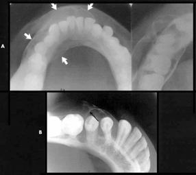 Central Giant Cell Granuloma Effects on adjacent structures May displace or resorb teeth Effaces
