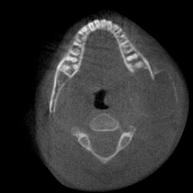 Occurs in individuals <30 yrs, mostly females Rapid bony swelling, painful Aneurysmal Bone Cyst Mandible to maxilla 3:2, molar region > anterior region