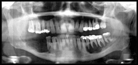Langerhans Cell Histiocytosis Swelling, pain,bleeding and loosening of teeth intraorally Well defined periphery of the lesions radiographically, sometimes punched out appearance Usually no root