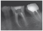 Maxillary right 1st molar,