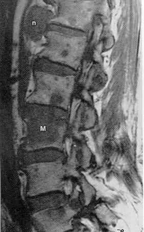 Metastatic Prostate Carcinoma on Spin-echo T1-weighted Sagittal MRI cortical bone: very low signal intensity intervertebral disks: intermediate signal intensity normal bone marrow: high signal