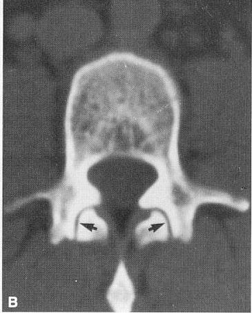 Review of the Normal Anatomy of a Lumbar Vertebra: Vertebral body: cortex trabecular bone Posterior Column elements: pedicle transverse process