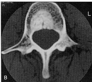 Answer: Metastatic Ovarian Carcinoma L3 RN bone scan is often needed to make the diagnosis Laredo JD, Quessar AE,