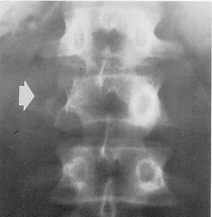 Congenital Absence of a Pedicle Right pedicle of L2 is absent Left pedicle of L2 exhibits compensatory hypertrophy