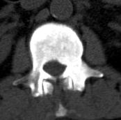 L2 on the Abdominal CT, Bone Window Sclerotic