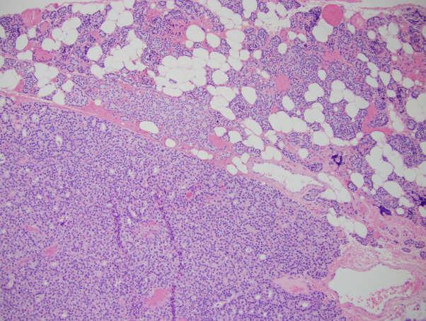 Parathyroid adenoma Parathyroid adenoma Women > Men, 3:1 Etiology: Sporadic, MEN syndrome, radiation exposure Histology: Well-circumscribed to vague hypercellular nodule devoid of stromal adipocytes