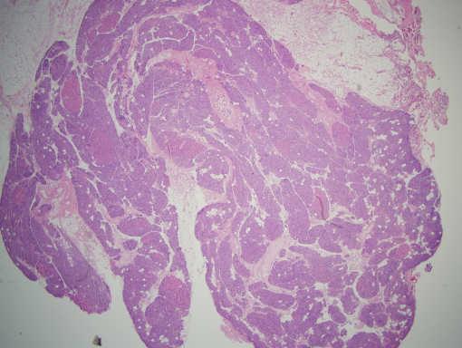 hyperplasia Hyperplasia of chief cells with uneven enlargement of all glands and marked