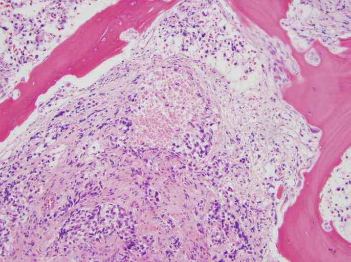 Histologic diagnosis Absolute criteria Invasion into surrounding tissues Features associated with malignancy Broad fibrous bands splitting tumor nodules (90%) Regional or distant metastasis Capsular
