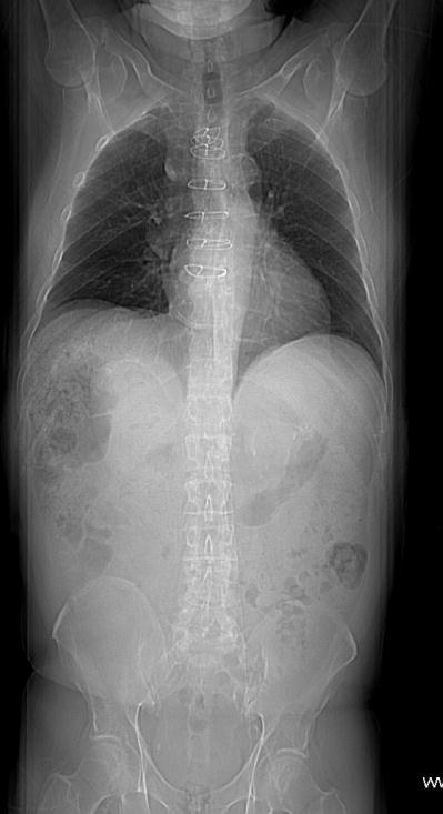 Imaging protocol: CTA abdominal aorta Bolus tracking AP and lateral scouts Bolus tracking at L1. ROI in abdominal aorta.