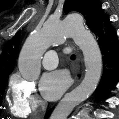 PT - CT aortogram: multifocal aneurysms