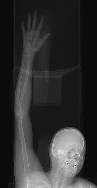 Imaging protocol: upper extremity CTA Distal
