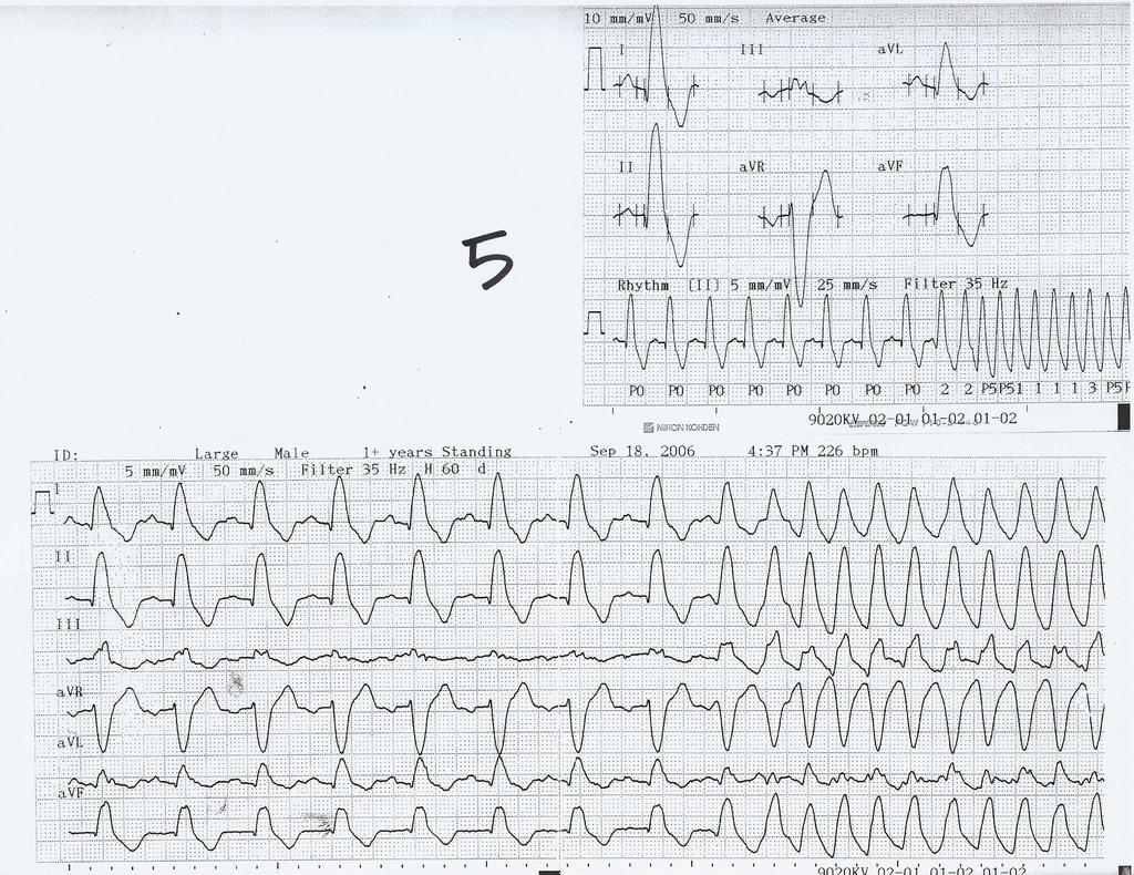 LBBB with acute onset