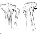 Lippert, p304 Joint Structure Superior Tibiofibular joint Articulation between head of fibula and the posterior lateral proximal tibia Plane joint,