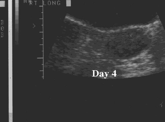14 of 16 5/3/2005 8:34 PM 2.) Serial monitor of follicular development beginning on day 8-10. On this study developing follicles of 8-10mm size allow early assessment of likely response. 3.