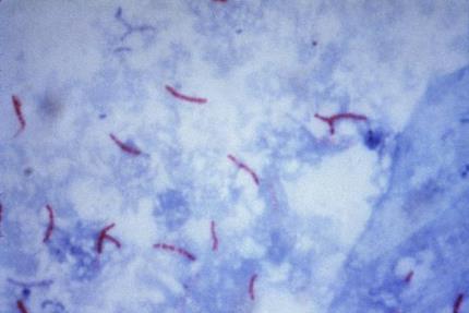 Laboratory Diagnosis of Tuberculosis AFB smear by ZN