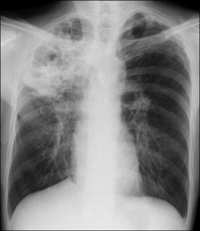 Pulmoary Tuberculosis Extrapulmoary Tuberculosis TB Pleural