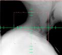 compared to MV: Patient Patient Patient 2-D kv radiographs - Better