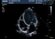 L/20 i=1 3D echo for volume and EF triplane imaging and manual tracing