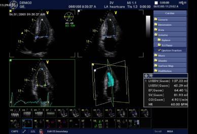 echocardiography by Simpson's method (3DS) vs radionuclide angiography
