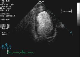 Use contrast for LVO to assess LV