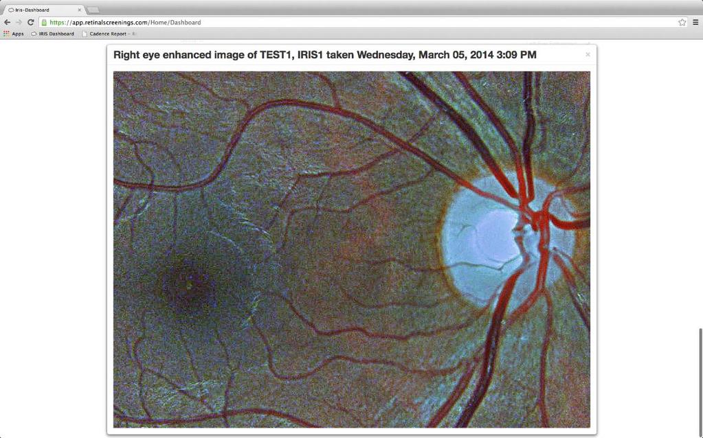 Figure 6 - Zoomed in view of enhanced right eye image 7.1.2.2 Communicate Notes for Graders On occasion, circumstances prevent a perfect fundus photo from being captured.