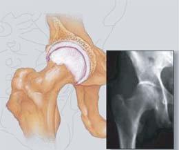 The capsule of the arthritic hip is swollen. The joint space is narrowed and irregular in outline; this can be seen in an X-ray image.