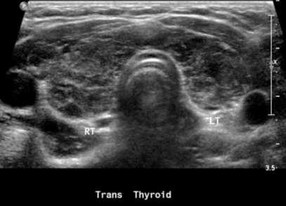 Hashimotos thyroiditis (late stage): US Heterogeneous and