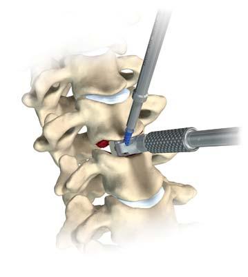 14 Veyron-C Anterior Cervical System Surgical Technique Screw Insertion Inserter Removal RELEASE Fig. 27 Fig. 28 Fig.