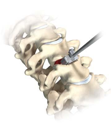Veyron-C Anterior Cervical System Surgical Technique 5 Discectomy and Endplate Preparation Implant Sizing Guided Inserter Assembly Fig. 2 Fig. 3 Fig.