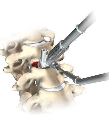 Turn the proximal knob clockwise to close the inserter and lock onto implant.