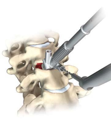 8 Veyron-C Anterior Cervical System Surgical Technique Fixed Angle Driver Screw Hole Preparation - Drill Drill Tap Driver Fig. 11 Fig. 12 Fig.