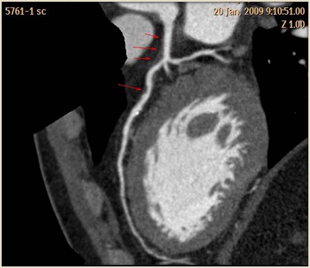 Keep in mind In younger patients suffering from atypical chest pain coronary calcifications may