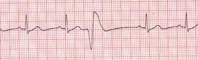 7 - Convinced of atrial nature of ectopics - Frequency less than 15 PACS per minute 1 (greater than this may initiate paroxysmal SVT) 2 - Otherwise normal ECG - No antenatal concerns for congenital