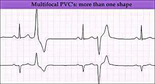origin from more than 1 ventricular site