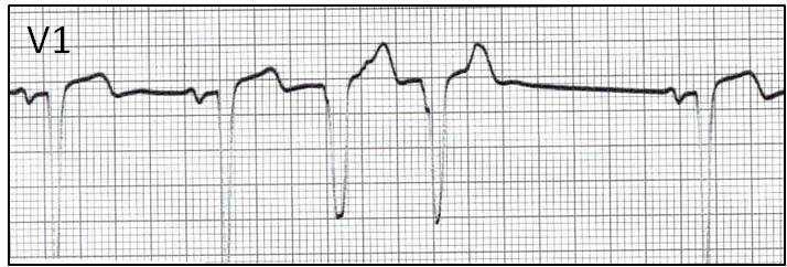 9 Occurring after 2 ventricular beats Trigeminy.