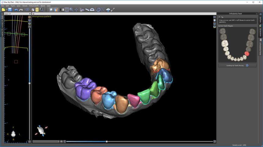 Software Solutions Meshmixer Dental Repairing models and scan cleanup Preparation for