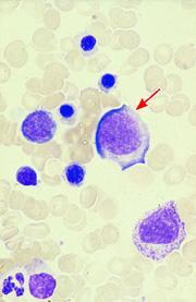 PROERYTHROBLAST Large cell, moderately to strongly basophilcic cytoplasm, round nucleus, finely stippled chromatin